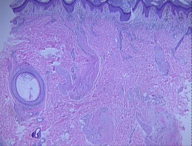 discoid lupus alopecia