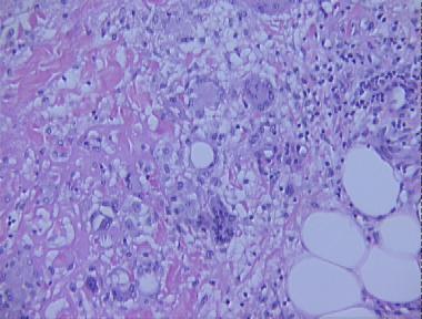erythema nodosum