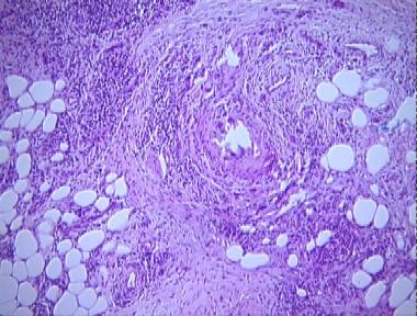 nodular vasculitis