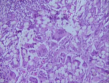 foreign body panniculitis