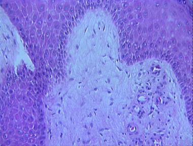 chronic lymphedema