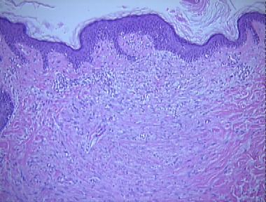 acne atrophic scar