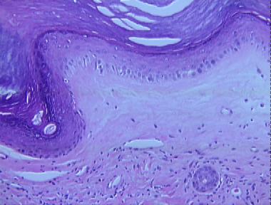 lichen sclerosis et atrophicus, old