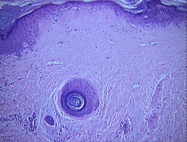 Degos' disease (malignant atrophic papulosis)