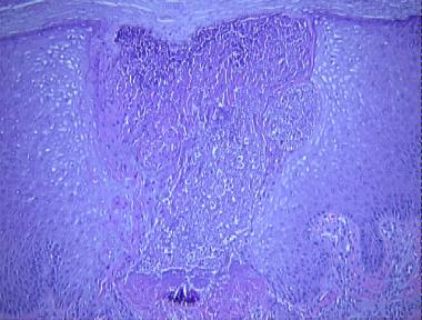 reactive perforating collagenosis