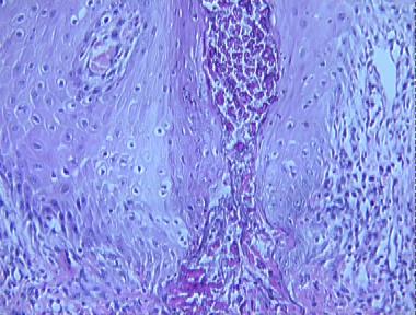 elastosis perforans serpiginosa