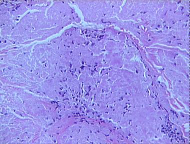 nodular amyloidosis