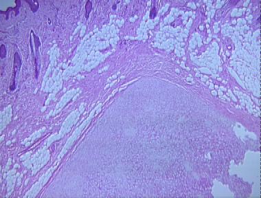 cutaneous chondroma