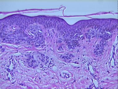 junctional atypical nevus with mild dysplasia