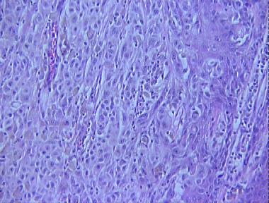 malignant melanoma, nodular type (nodular melanoma)