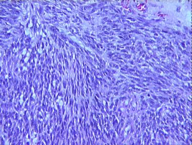 spindle cell melanoma, pigmented