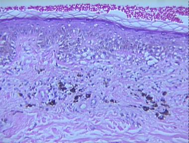 regressed melanoma