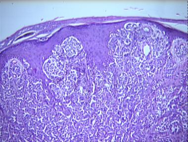 epidermotropic metastatic melanoma