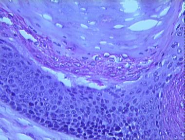 pilomatrixoma (Calcifying epithelioma of Malherbe)