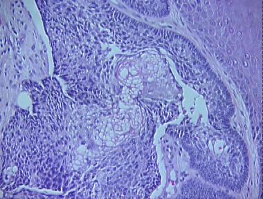 sebaceous adenoma