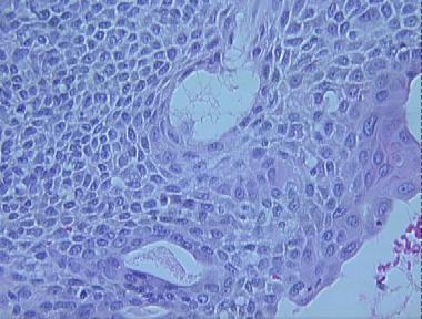 eccrine poroma