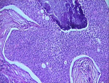 eccrine porocarcinoma