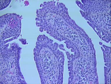 syringocystadenoma papilliferum