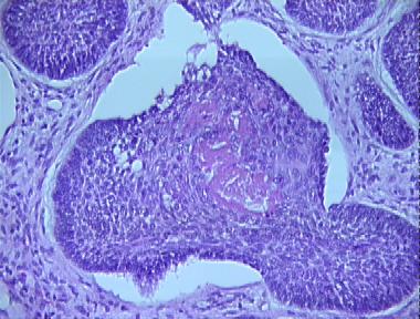 basal cell carcinoma, nodular type