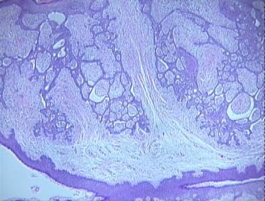 fibroepithelioma of Pinkus