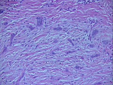 Morpheaform Basal Cell Carcinoma Histopathology Loma Linda