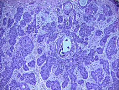 basal cell carcinoma, micronodular type