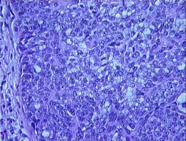 basal cell carcinoma with sebaceous differentiation