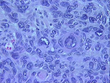 bowenoid basal cell carcinoma
