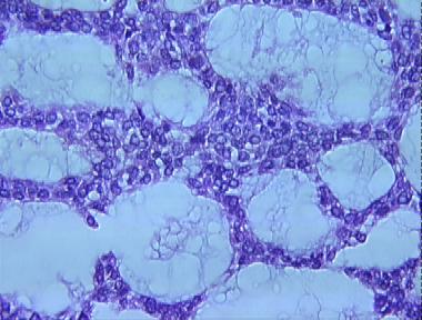 basal cell carcinoma, adenoid type