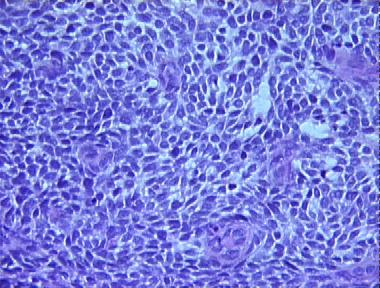 Adamantoid Basal Cell Carcinoma Histopathology Loma Linda