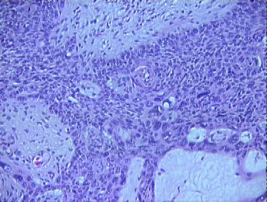 basosquamous carcinoma