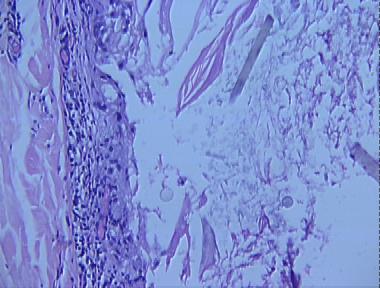 eruptive vellus hair cyst