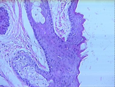 steatocystoma (sebaceous duct cyst)