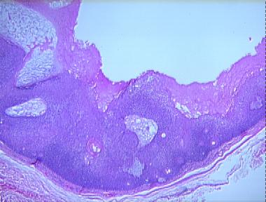 proliferating trichilemmal cyst (pilar tumor of the scalp)