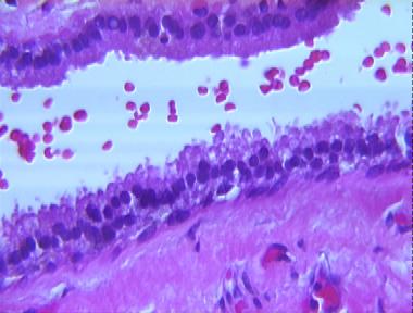 apocrine hidrocystoma