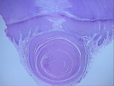 epidermal inclusion cyst