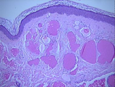 nevus flammeus (port-wine nevus)