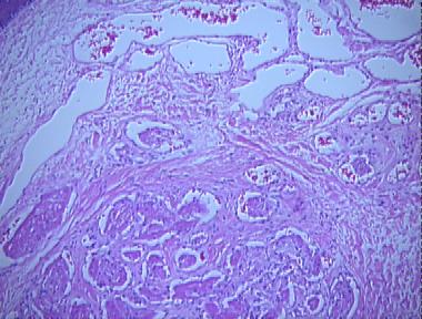 capillary hemangioma