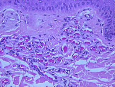angioma serpiginosum