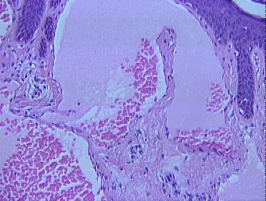 lymphangioma