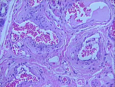 cavernous hemangioma