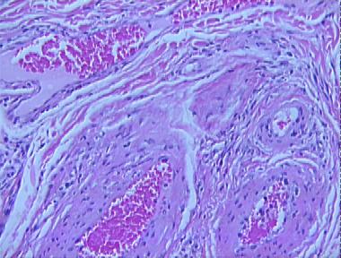 phlebangioma (arterial venous hemangioma)