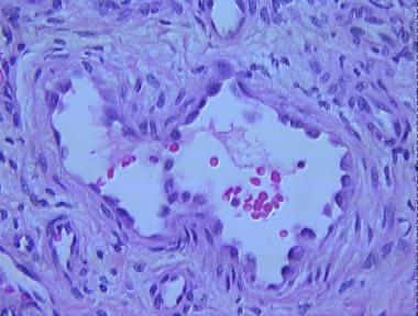 angiolymphoid hyperplasia with eosinophilia