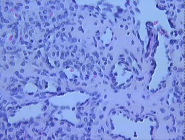 histiocytoid hemangioma