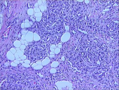 infantile capillary hemangioma