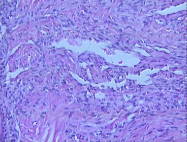 Kaposi's sarcoma, plaque stage