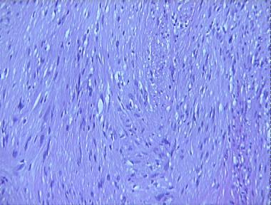 ancient schwannoma