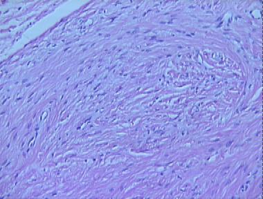 ancient neurofibroma
