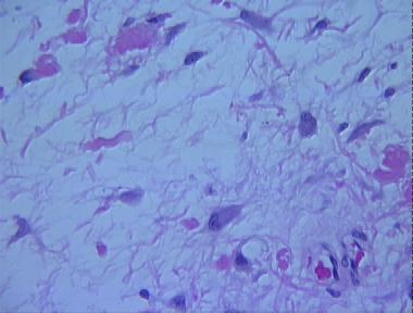 myxoid malignant fibrous histiocytoma