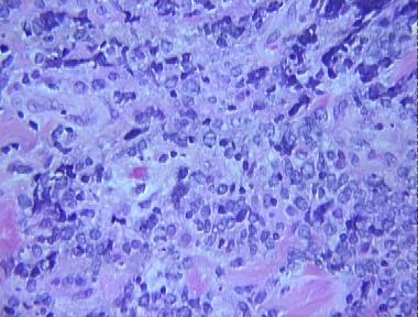 extraskeletal Ewing's sarcoma